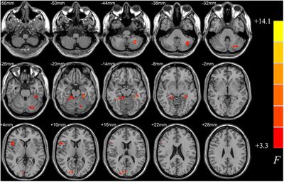 Abnormal Spontaneous Brain Activity in Early Parkinson’s Disease With Mild Cognitive Impairment: A Resting-State fMRI Study